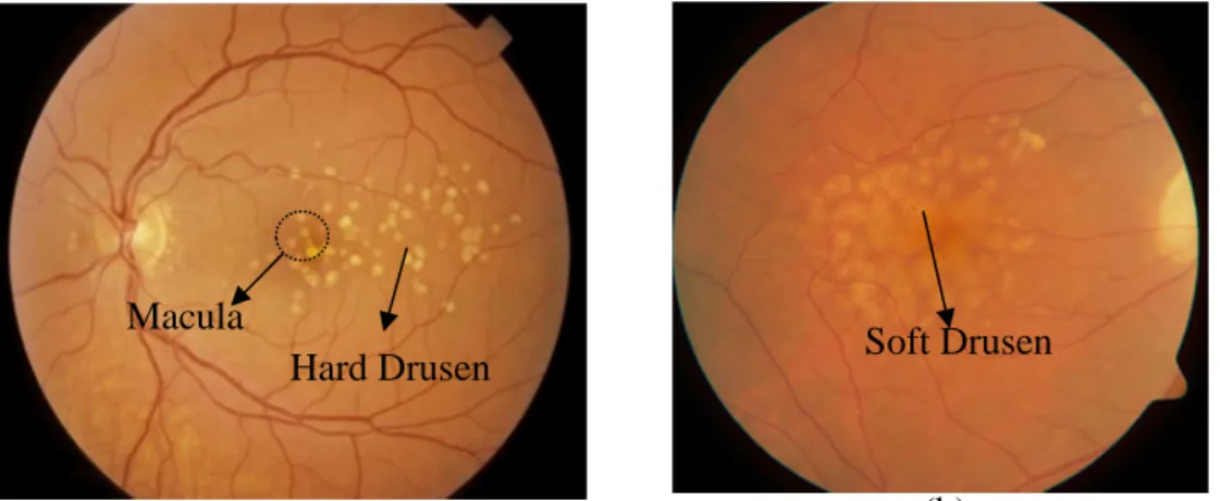 Figure 1.8  Two forms of age-related macular degeneration (AMD). The bright spots in  (a) are hard drusen; (b) is wet AMD with soft drusen.