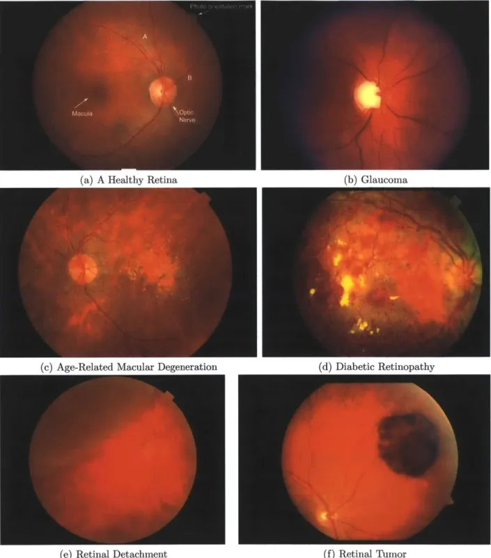 Figure  1-4:  Comparison  of the various  Retinal  Diseases.  These  images  were  captured using  a  standard  fundus  camera