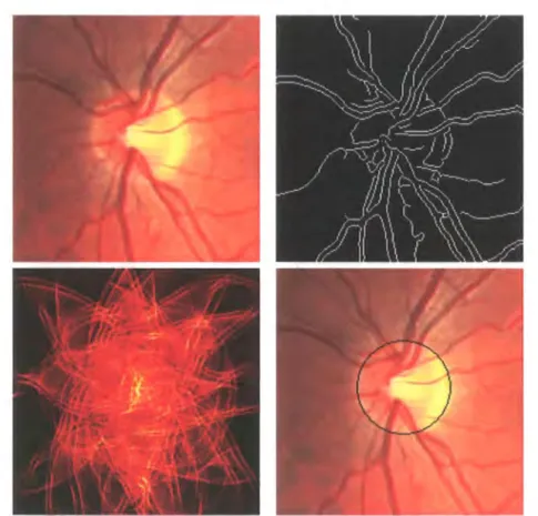 Figure  3.5:  Circular  Hough  Transform  a)Colour  fundus.  b)Canny  edge  map.  c)Circular  Hough  Transform