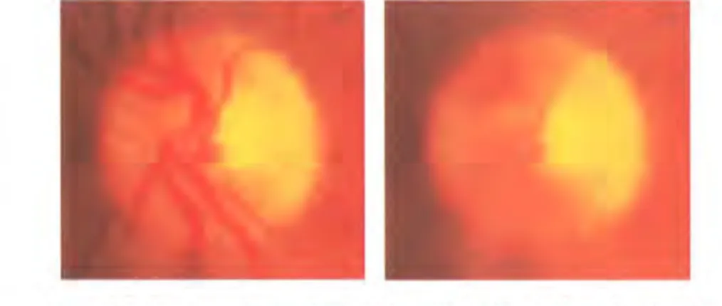 Figure  3. 7:  The  O ptic  Nerve  Head.  a)  Norm al.  b)  Morph ologically  Closed. 