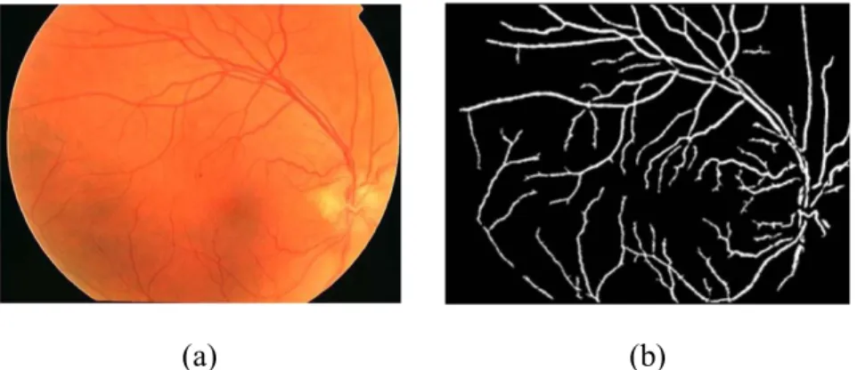 Figure 3.  Results of vessel detection: (a) retinal image (b) detected vessels [14] 