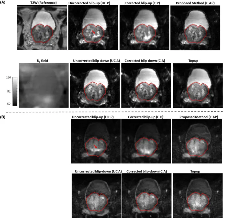 Figure 8 shows the usefulness of phase correction used in  the proposed method for patient 11 and patient 1 for data  combined from a pair of dynamics acquired with diffusion  weighting (b‐value of 500 s/mm 2 )