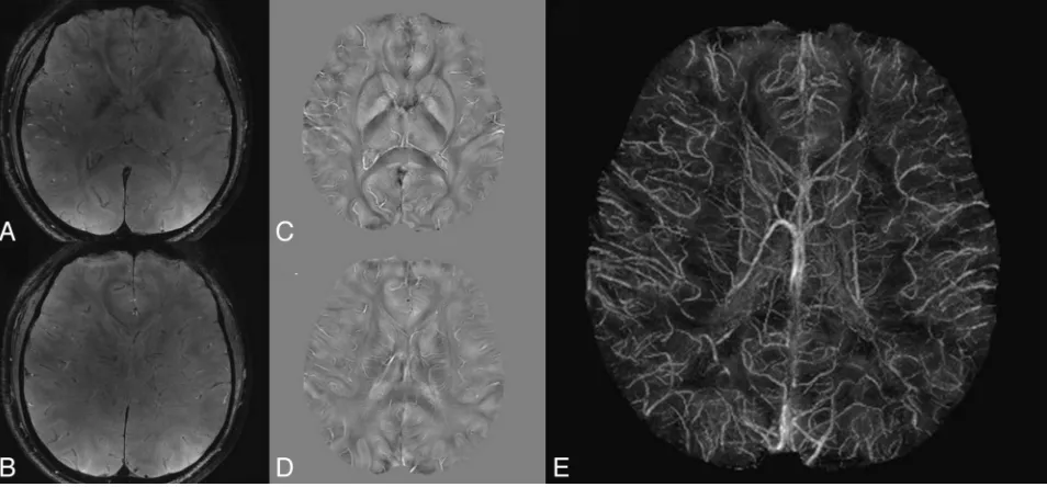 FIG 5. Quantitative magnetic susceptibility mapping in a volunteer at 7T. A and B, Gradient-echo weighted images
