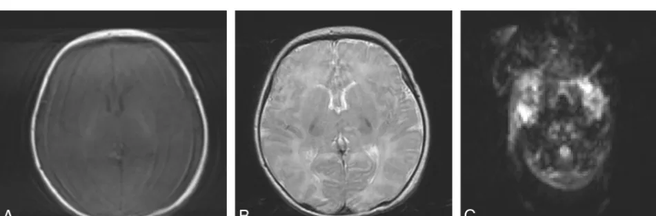 FIG 1. T1-weighted (A), T2-weighted (B), and diffusion-weighted (C) axial MR brain images of a 5-day-old full-term neonate without motionartifacts acquired at 1.5T.