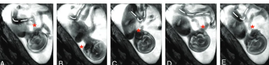 FIG 3. T1-weighted gradient-echo axial brain images at 1.5T (TR, 142 ms; TE, 6 ms; section thickness, 4 mm; scanning time, 16 seconds) of aBreathing artifacts appear in the form of high-signal ghosts in the operator-selected phase-encoding direction and severely degrade image28-week-old fetus without motion artifacts after a successful breath-hold (A) and with motion artifacts after an incomplete breath-hold (B).quality.