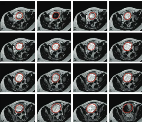 FIG 5. Successive axially planned sections of a single-shot fast-spin-echo acquisition at 1.5T (TR, 1000 ms; TE, 127 ms; section thickness, 4 mm;(plane, fetal movement resulted in plane transposition in the produced images (scanning duration, 26 seconds) o