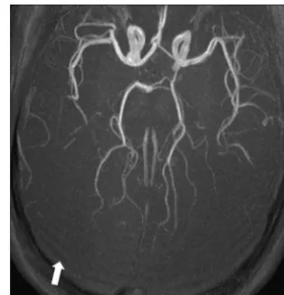 FIG 6. Ringing artifacts (ing artifacts occur due to data undersampling, and should not bearrow) at the back of the brain of a 4-week-old full-term neonate on an axial maximum intensity projection of anoptimized neonatal MR angiography protocol79 acquired 