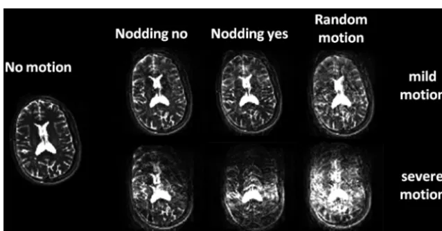 FIG 7. The effect of varying imaging-acquisition parameters such as TR ((range, 25–1000 ms) and the faster the motion (measured in cycles/minute; range, 12–48 cycles/min) (the bigger the amplitude of motion (measured in centimeters; range, 1–3 cm), the bri