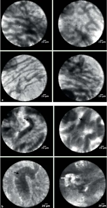 Fig. 3 Bile duct. a Normal appearing bile duct with fine, reticular gray pattern (thin black arrow)