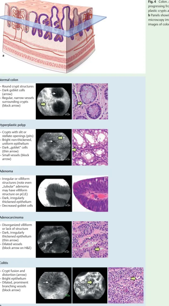 Fig. 4 Colon. a Graphic showing colonic mucosa progressing from normal crypts (left side) to  dys-plastic crypts and villiform structures (right side).