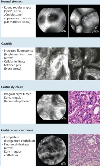 Fig. 6 Duodenum. Probe-based confocal laser endomicroscopy (pCLE) images and hematoxylin and eosin of normal and diseased duodenum