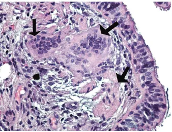 Figure 4: Lung peribronchial tissue on high power (shows ciliated pseudostratified columnar epithelium (Hematoxylin400) showingnonnecrotizing granuloma comprised mainly of multinucleatedgiant cells (black arrows) and epithelioid cells