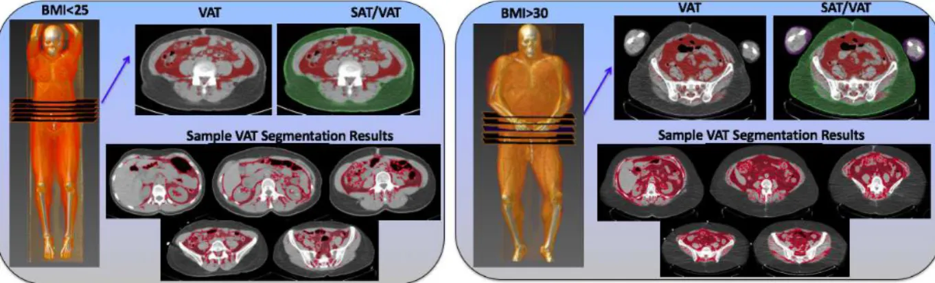 Figure 3.4: Visceral Adipose Tissue (red) and Subcutaneous Adipose Tissue (green) segmenta- segmenta-tions are illustrated for two subjects (one with BMI< 25, another with BMI> 30) at the chosen abdominal slice level along with their volume rendering