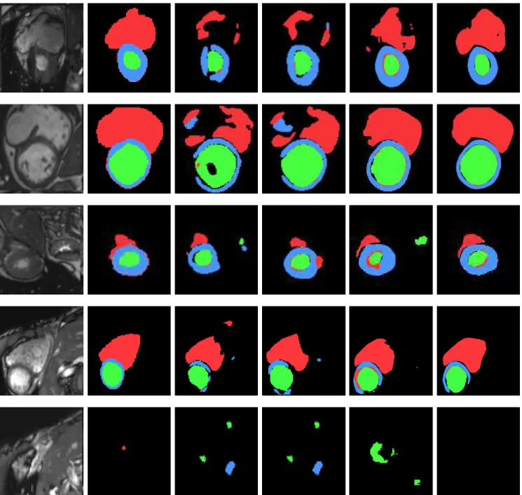 Figure 3: Segmentation results of left ventricle (red), right ventricle (green) and myocardium (blue) of five examples images using 2D U-Net and 2D Dense-Net with CE and our AC loss functions