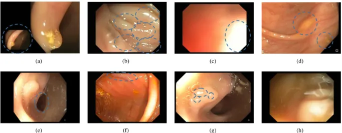 Fig. 3. Examples of the 8 technical and clinical challenges selected for the study: (a) Presence of overlay information; (b) High presence of specular highlights; (c) Overexposed regions; (d) Intestinal content; (e) Luminal region; (f) Polyp cannot be seen