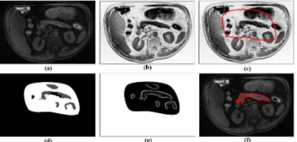 Fig. 2. Visualisation of results for a slice from image volume. (a) Original MRI slice, (b) MRI slice after contrast enhancement, (c) Red bounding box depicts major  pan-creas region, (d) Segmentation following max-flow and min-cuts approach, (e)  Bound-ar