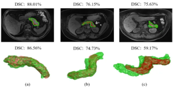 Fig. 3. Segmentation results for three different volunteers. From left, first column dis- dis-plays sample MRI axial slices with segmentation outcome (green) against ground-truth (red), and computed DSC; second column displays 3D reconstruction of entire p
