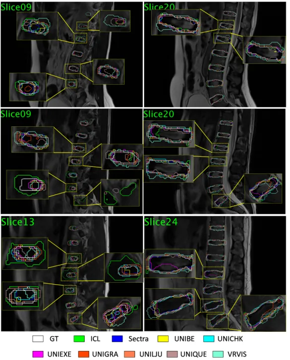 Figure 6: Visual comparisons of segmentation results on case 1 (top row), 3 (middle row), and 5 (bottom row) of Test1 data
