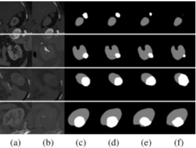 Fig. 4. Segmentation results of different models. Here (a) CTA (b) CTU (c) ground truth (d) SCNet + 2-step loss (e) PSPNet (f) U-Net.