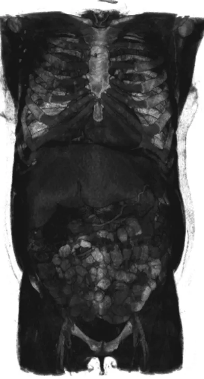 Figure 6.2: 3D view of an abdominal CT scan. The LUT parameters of the MeVisLab viewer are adjusted to show some of the internal structures of the body and not only the skin