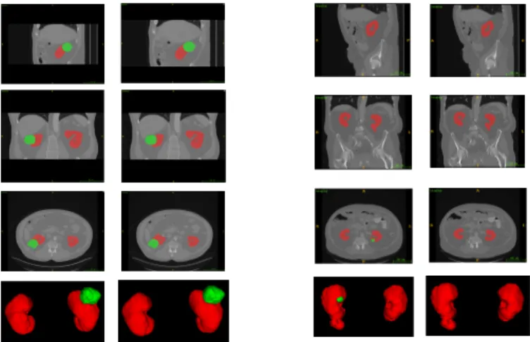 Fig. 4.  Two samples of our segmentation outputs. The rows from up to bottom are sag- sag-ittal, coronal, transverse plane in 2D and the 3D view (best viewed in color)