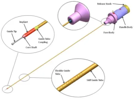 FIGURE 1. Deployed Implant at the Left Fallopian Tube 