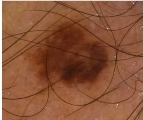 Figure 8   A dermatoscopic image 398 x 339 pixels of a skin lesion with hair 
