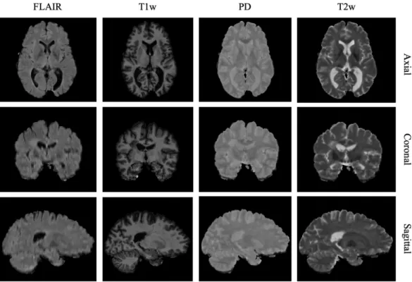 Figure 1.1: An example of a subject from the ISBI dataset with four MRI modalities (FLAIR, T1w, T2w and PD) visualized through orthogonal views of the brain (axial, coronal and sagittal planes).