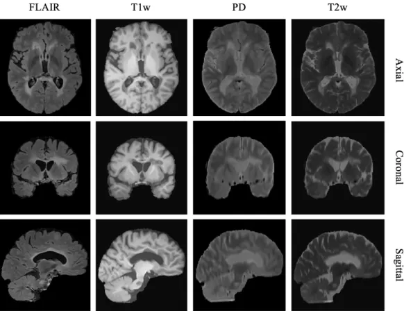Figure 1.2: An example of a subject related to NRU dataset with four MRI modalities (FLAIR, T1w, T2w and PD) visualized through orthogonal views of the brain (axial, coronal and sagittal planes)