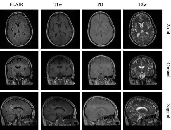 Figure 1.3: An example of a subject from the UBC dataset with four MRI modalities (FLAIR, T1w, T2w and PD) visualized through orthogonal views of the brain (axial, coronal and sagittal planes)