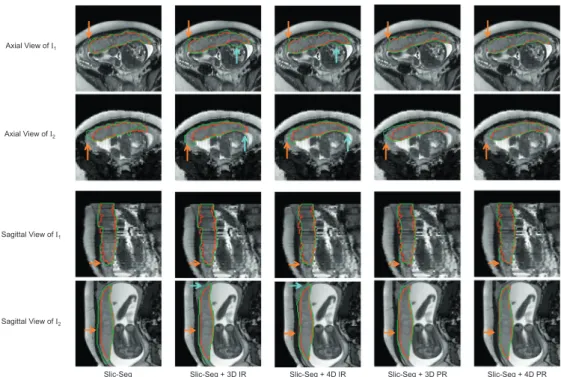 Fig. 9. Comparison of initial segmentation by single volume Slic-Seg and reﬁnement by 3D/4D Graph Cuts using intensity/probability respectively