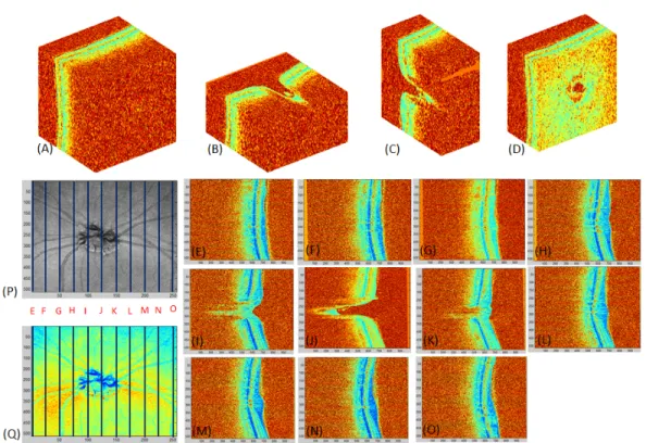 Figure 2.12: The SD-OCT example images taken by using the Spectralis HRA+OCT system around the ONH area.