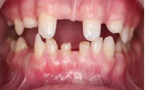 Figure 6: Intra-oral view of the patient before treatment          