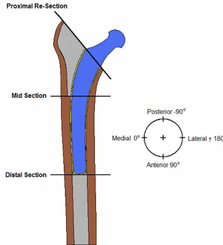 Figure 4.  Tresca stress distribution in intact femur under different loading 
