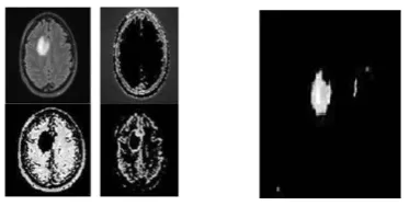 Fig 2: Brain tumor segmentation based on a hybrid clustering technique [4] 