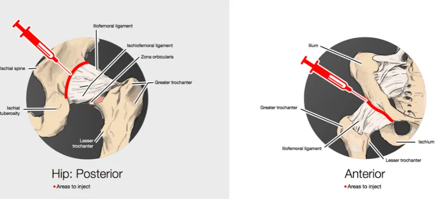Figure 2 Examples for areas treated on a shoulder: injection is at the enthesis (in bone contact), on the side where the shoulder dislocates (some shoulders dislocated in both directions, but posterior dislocation was more common); and inject where it is tender (in red).
