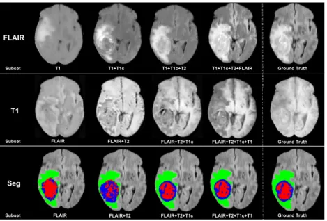 Fig. 3. Example of FLAIR and T1 completion and tumour segmentation given a subset of modalities as input