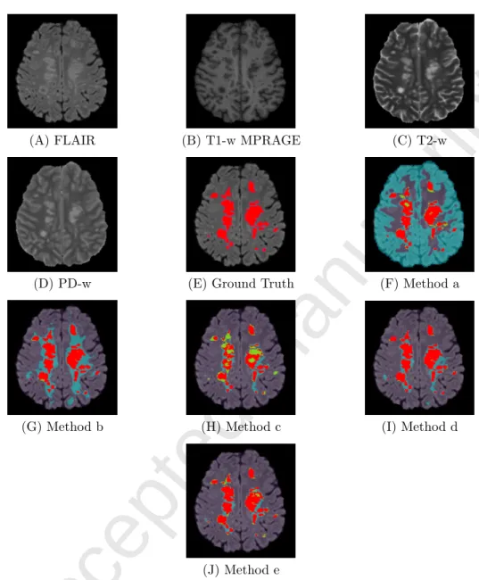 Figure 3: Comparison of MS lesion classification methods, example 1 - patient 6, slice 164
