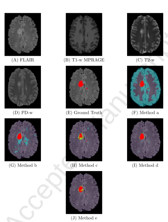 Figure 4: Comparison of MS lesion classification methods, example 2 - patient 4, slice 153