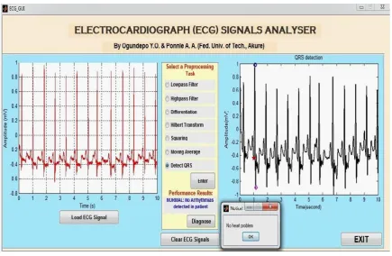 Figure 6: GUI display of an ECG signal (MIT-BIH database), processed and diagnosed to be Normal