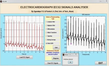 Figure 7: GUI display of an ECG signal (MIT-BIH database), processed and diagnosed to be Abnormal