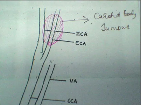 Figure 4: Schematic description of carotid body tumor in relation to external and internal carotid artery