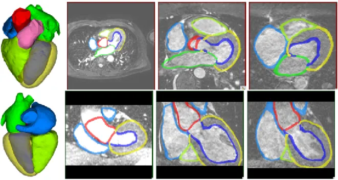 Figure 2.8 – Whole heart segmentation result using deformable models [Peters et al., 2007].