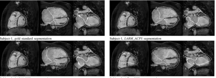 Figure 2.11 – Comparison of manual segmentation, Affine+FFD, LARM+FFD, and LAR- LAR-M+ACPS