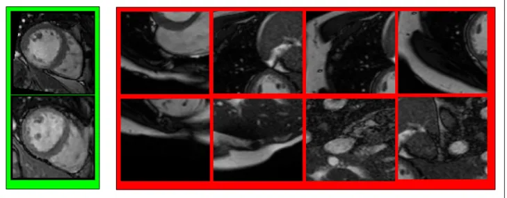 Figure 4.2 – Positive (green) and negative (red) examples from the training set for the cardiac detector.