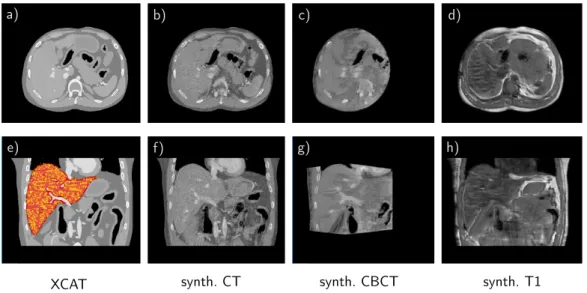 Figure 4.4: Axial and coronal slices extracted from the digital XCAT phantom a) + e) with mask (shown in red) and artifical landmarks (shown in yellow) as well as slices of the synthetically generated CT b)+f), CBCT c) + g) and T1 d) + h) data based on thi