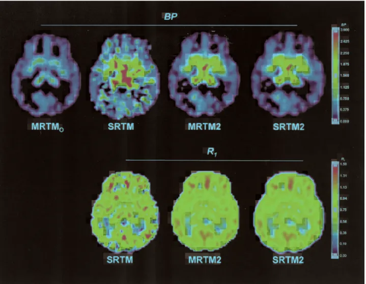 Fig. 9 shows examples of BP and R 1 parametric im- im-ages estimated by MRTM2 and the corresponding  mag-netic resonance images from the same subject
