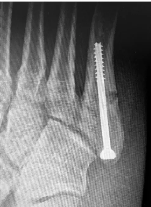 Figure 1  X-ray of one players’ fifth metatarsal stress fracture (insidious onset) after surgical fixation with an intramedullary screw