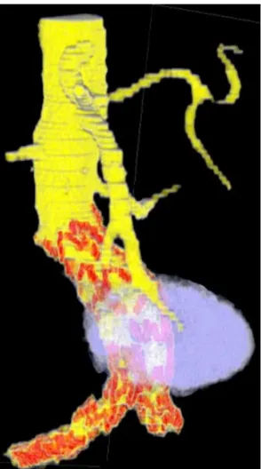 Figure 2.10: Volume rendering of Abdominal Aortic Aneurysms [59]