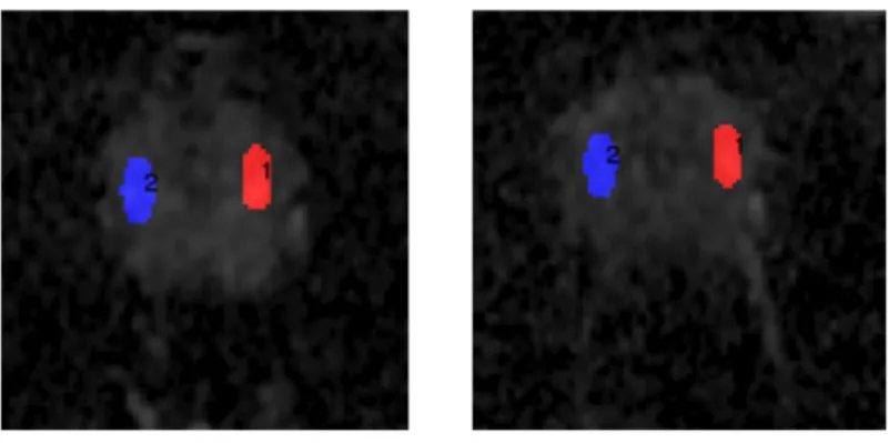 FIGURE 7. Example of ROI placements for one of the volunteers. The ROI are placed in a homogeneous  area in the peripheral zone